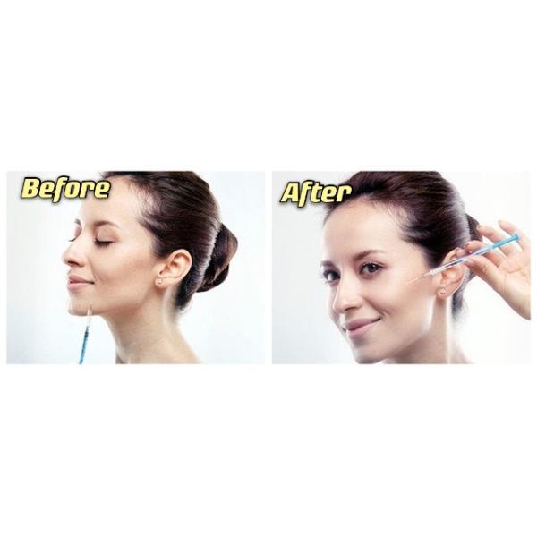 Injection Meditoxin Botulax For Face Removal Wrinkle