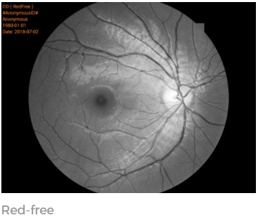 Non Mydriatic Automatic Fundus Camera Retinal Fundus Camera Imaging Red Free