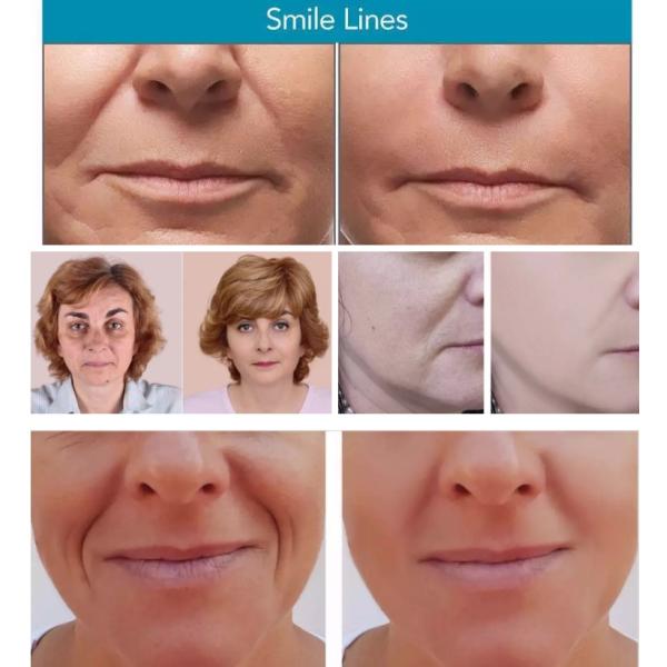 Forehead Lines Cross Linked Dermal Filler With