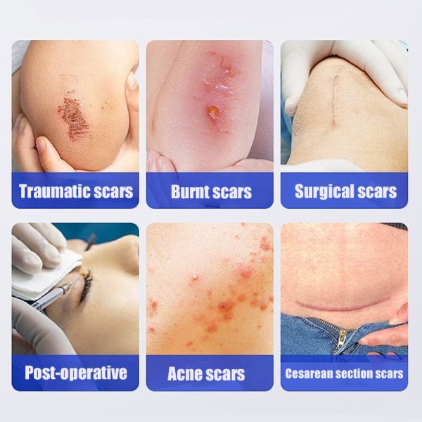 Scar repair cream, fades old scars and prevents new scars.