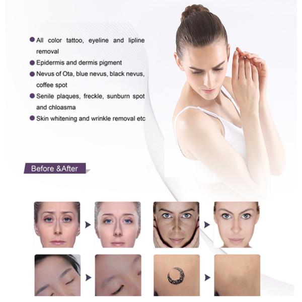 LCD Screen Laser Tattoo Removal Machine / Pico Laser Remove Tattoo And Pigmentation