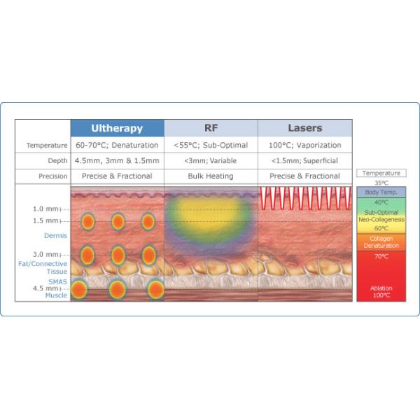 non-invasive,clinically effective,evidence-based Wrinkle removable and facelifting sincoheren HIFU