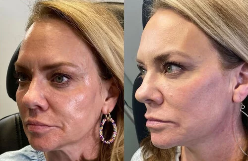Aesthetic PLLA Replace Lost Collagen For Face Lifting