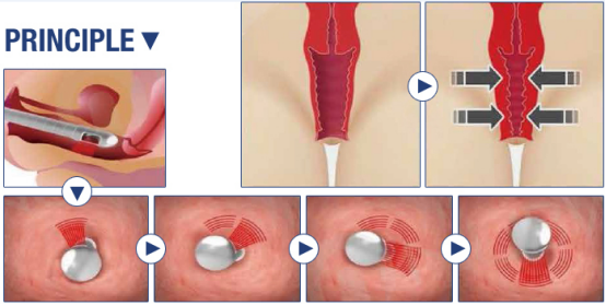 Vertical Design Rf Co2 Fractional Laser Machine With Vaginal Tightening Function