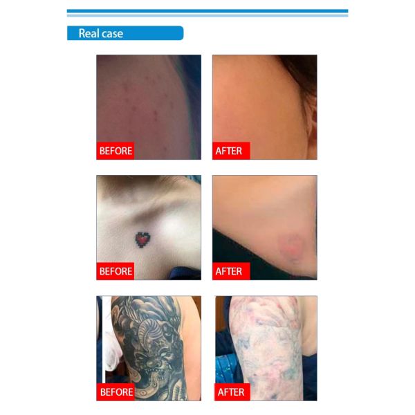 tattoo removal machine