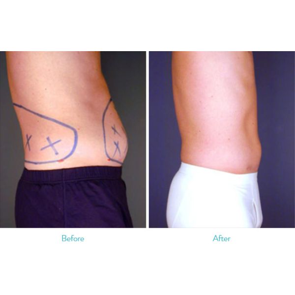 300W Surgical Abdomen Liposuction Slimming Machine