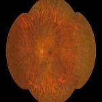 176 deg Wide Field Fundus Camera with AI Intelligent System and One Key
