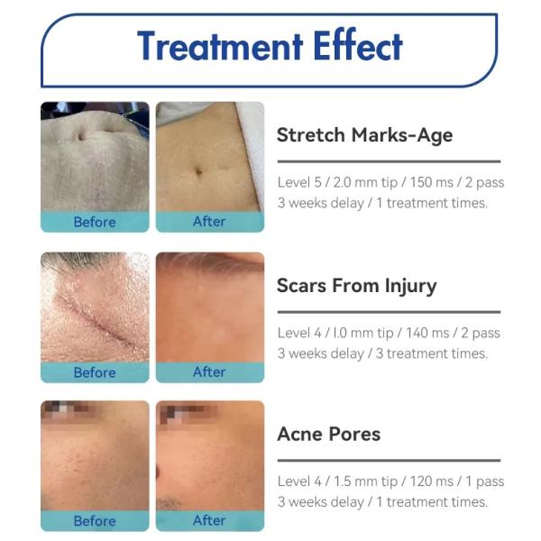 Wrinkle Removal Secret RF Machine