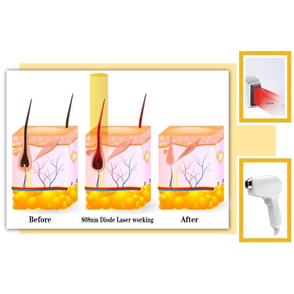Self - Protection Diode Laser Hair Removal Machine With Semiconductor Cooling System