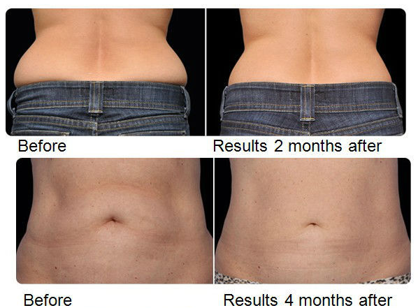 Fat Reducing Vacuum RF Slimming Machine With Massage Roller FDA Approved