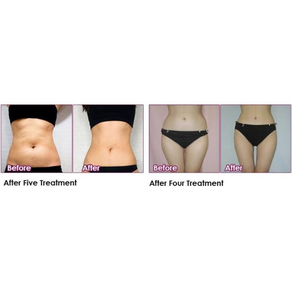 Lipolytic Slimming Fat Dissolving Solution For Face Double Chin Belly Body