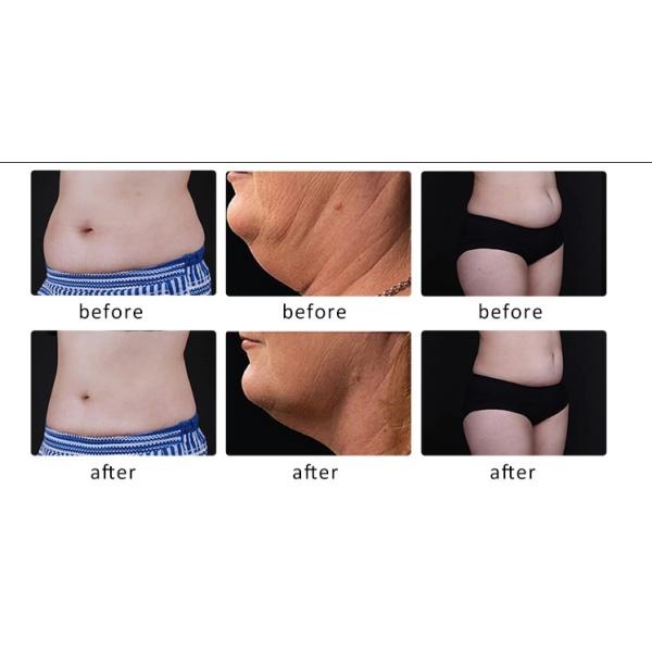 Five Handles Double Chin Fat Freezing Machine Criolipolisis Cellulite Machine