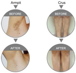 Pulsed Light Diode Laser Hair Removal Machine
