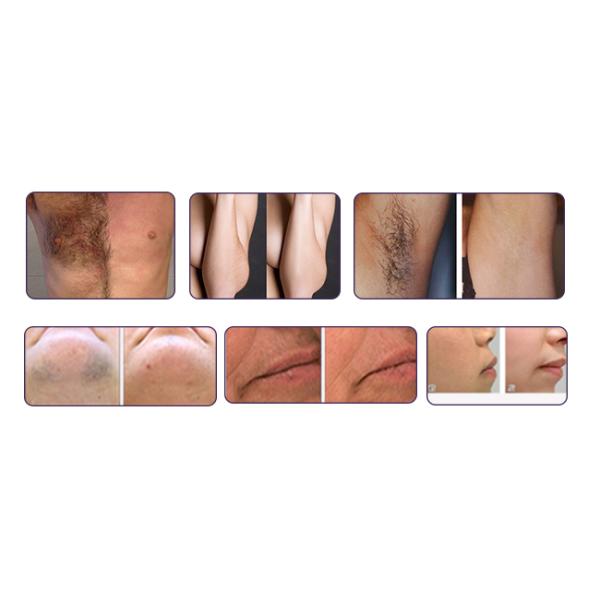 High Safety Diode Laser Hair Removal Machine 5 ~ 400ms Adjustable Pulse Width