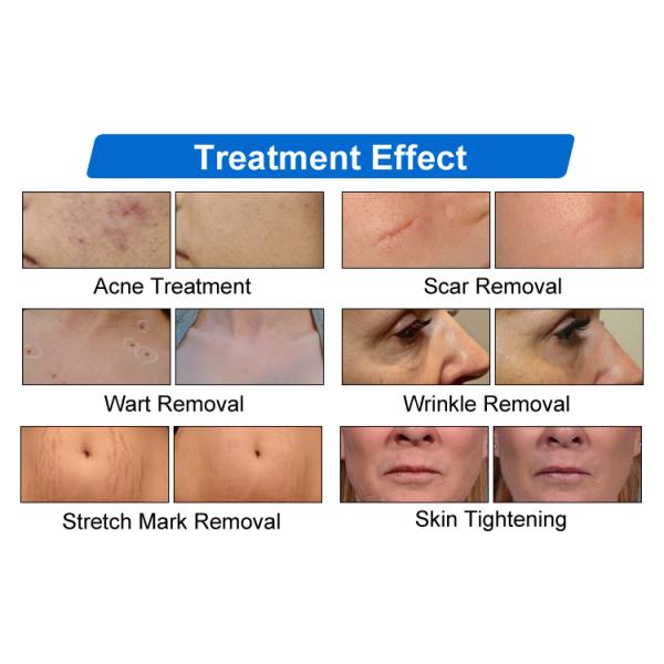 Advanced Four Treatment Modes Co2 Fractional Laser Machine Effective Stretch Marks Removal