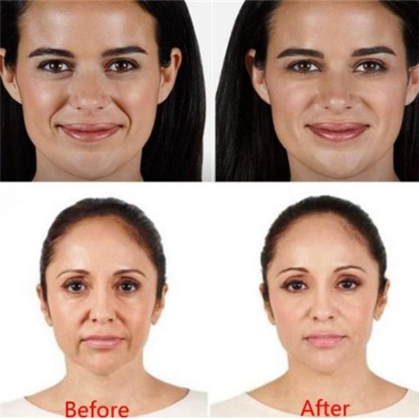 Forehead Lines Cross Linked Dermal Filler With