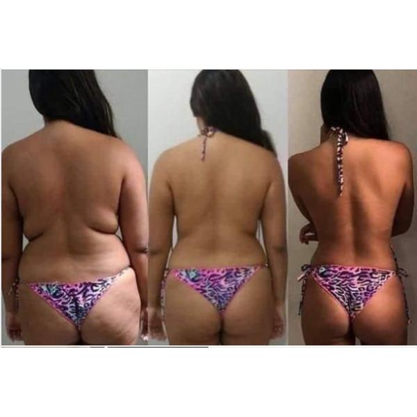 before after body slimming cryolipolysis
