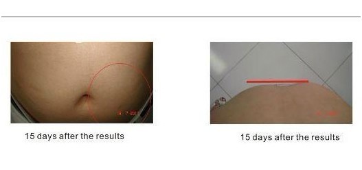 Face Thinner Cryolipolysis Machine with Cold Laser RF Vacuum