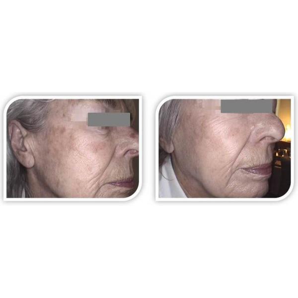 RF bodying slimming equipment
