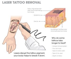 best laser tattoo removal machine