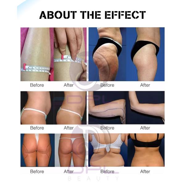 DPL Slimming System 80k cavitation slimming Liposuction Machine V shape Vacuum Lipo Cavitation Machine