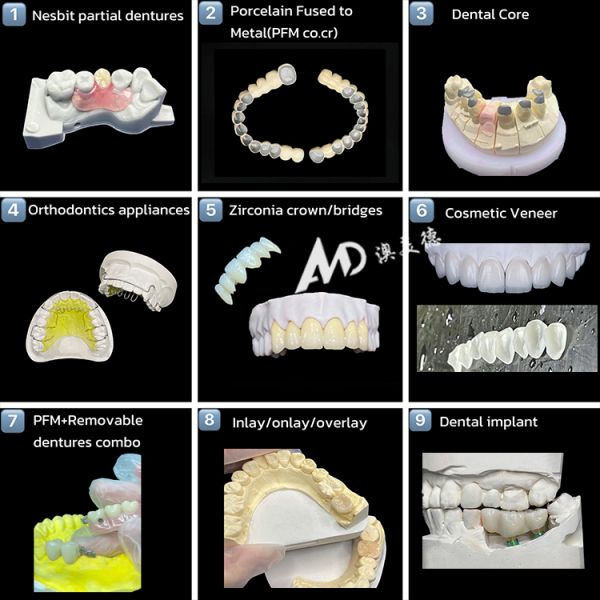 Custom Metal Framework Partial Denture with Invisible Clasps for Precision Fit and Superior Esthetics