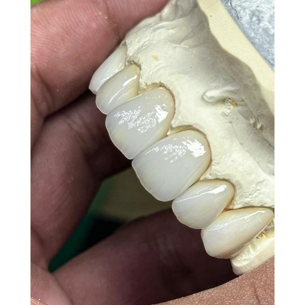 Transluency Layered Zirconia Crown for Optimal Functionality and Natural Aesthetics