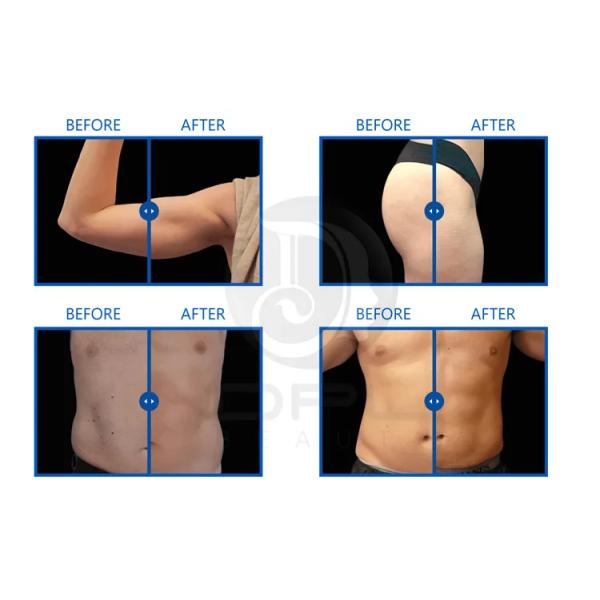 2 In 1 Vacuum Roller Butt Lifting Inner Ball Roller Slimming Machine Weight Loss Buttock Augmentation Breast Augmentation
