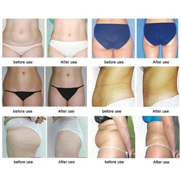 Korea Technology 10ml Lipolysis Lipolytic Solution Fat Dissolving Fat Burning