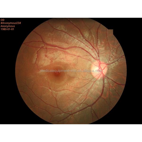 Portable Digital Fundus Camera with Ce Approval (HA06)
