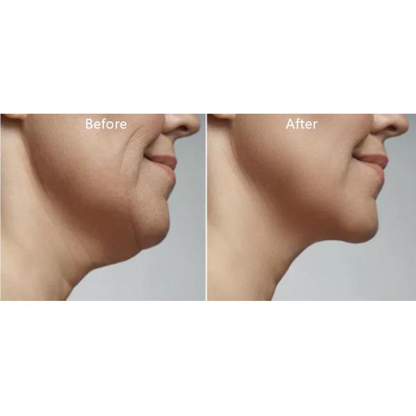 Fat Dissolving Injections To Lose Weight And Shape