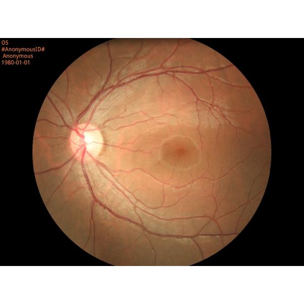 Portable Digital Fundus Camera with Ce Approval (HA06)