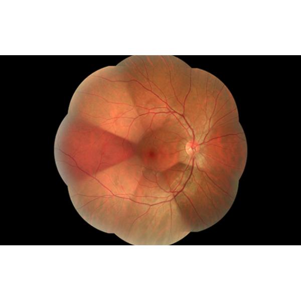 Non Mydriatic Fundus Camera With Auto Focus Alignment And Eye Fundus Alignment
