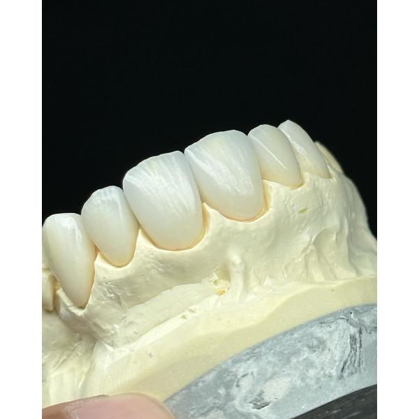 Transluency Layered Zirconia Crown for Optimal Functionality and Natural Aesthetics