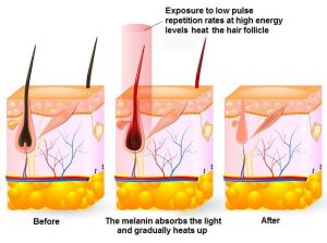 Triple waves diode laser hair removal