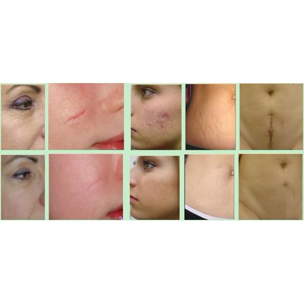 protbale CO2 Fractional Laser beauty machine with CE