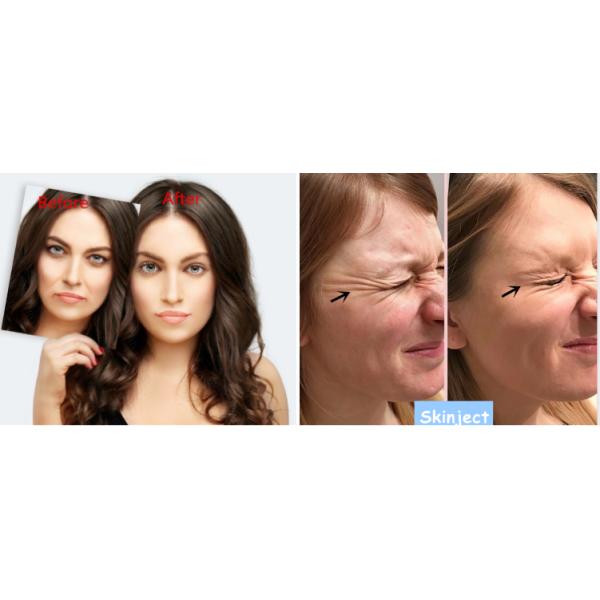 Injection Meditoxin Botulax For Face Removal Wrinkle