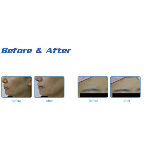 High technology improve double chin small bubble facial dermabrasion machine with CE