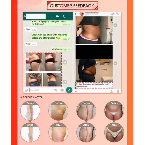 Multifunctional RF Cavitation Cryolipolysis Machine 5 Treatment Models