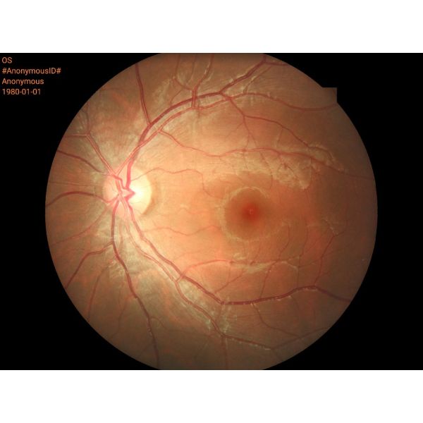 Portable Digital Fundus Camera with Ce Approval (HA06)