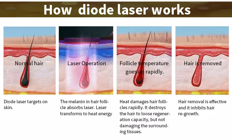 Soprano Ice Platinum Diode Laser