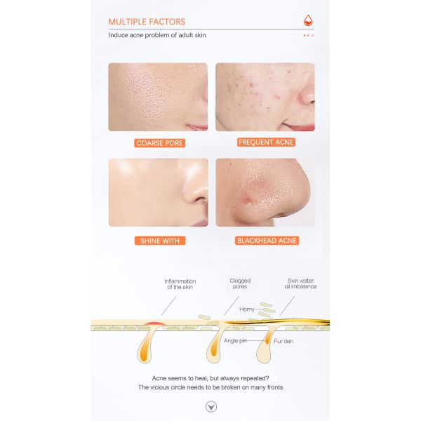 Toner For Oily Acne Prone Skin Hydrating Facial Toner AHA BHA Salicylic Acid Face Mist