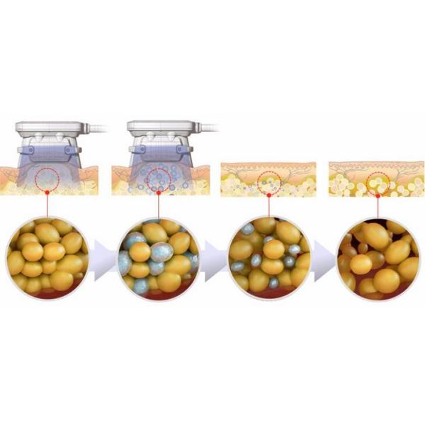 Fat Coolplas Body Firming Touchscreen Cellulite Reduction Machine