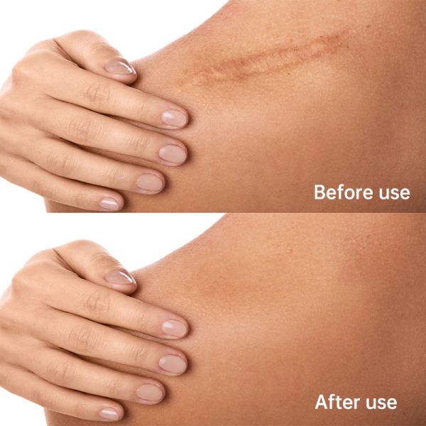 Scar Repair Cream - Effectively removes new and old scars, surgical scars, post-cesarean section scars, burn scars, scald scars, and pathological