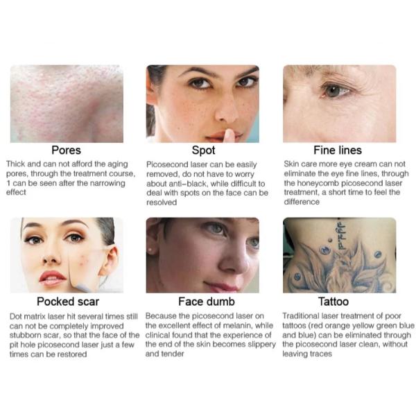Efficient Carbon Peeling Laser Picosecond Tattoo Removal Machine with 3 Wavelength 755nm 1064nm 532nm