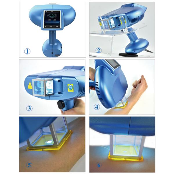Phototherapy Excimer Laser Technology