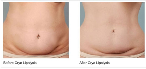 Body Slimming / Shaping Cryolipolysis Fat Freezing Machine With Intelligent Temperature Control