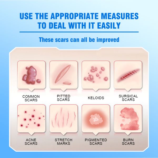 Scar Repair Cream - Effectively removes new and old scars, surgical scars, post-cesarean section scars, burn scars, scald scars, and pathological