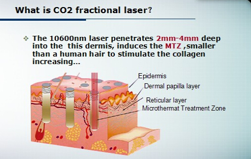 Professional CO2 Fractional Laser Machine For Stretch Marks Removal , CE Approved