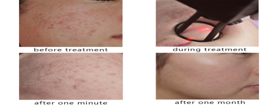 Vertical Design Rf Co2 Fractional Laser Machine With Vaginal Tightening Function